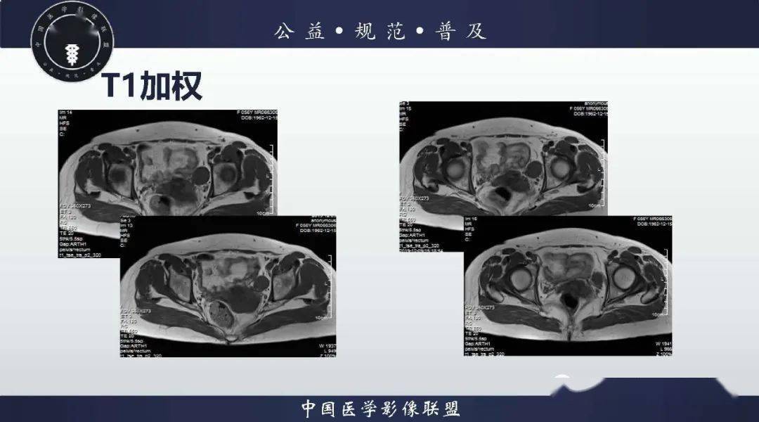 神经纤维瘤病（腹膜后及女性病例）医学影像特征与分析